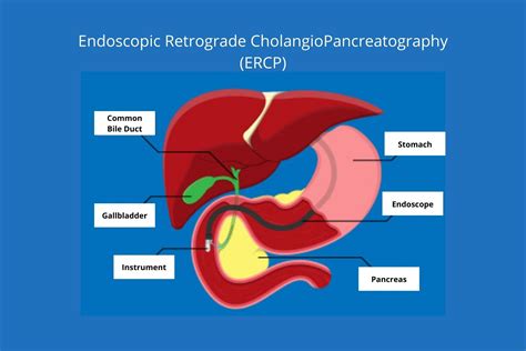 Endoscopic Retrograde CholangioPancreatography (ERCP) procedure