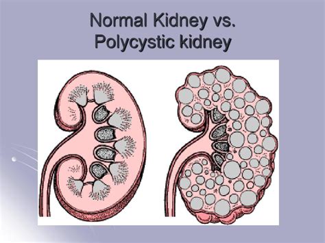 PPT - Genetics and Pathogenesis of Polycystic Kidney Disease PowerPoint ...