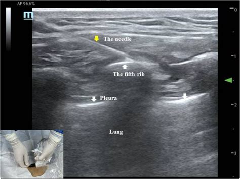 Ultrasound guided Serratus anterior block procedure. | Download ...