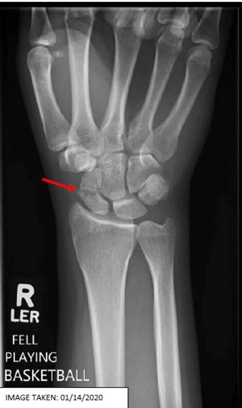 Scaphoid bone fracture - rightnetworking