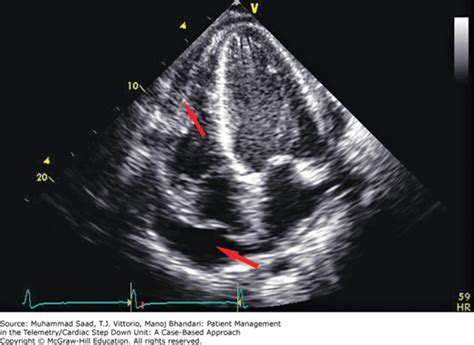 Abnormal Electrocardiogram, Echocardiogram, and Miscellaneous Imaging ...