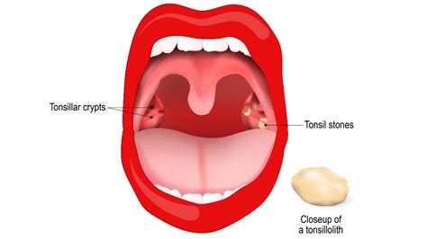 foods to eat after tonsillitis - In Malcolm