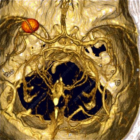 Cerebral aneurysm, CT scan - Stock Image - M136/0206 - Science Photo ...