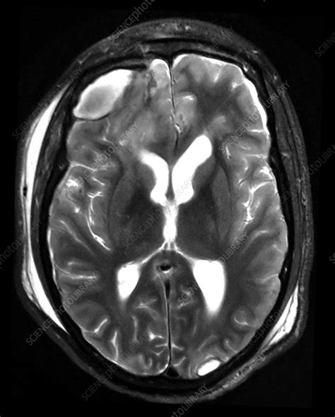 Traumatic Brain Injury MRI - Stock Image - C043/2968 - Science Photo ...