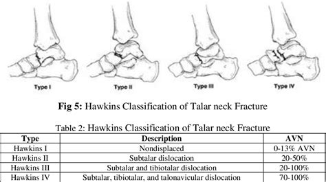 Table 2 from Talus fracture-A myth | Semantic Scholar