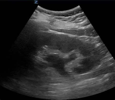 Normal Kidney Ultrasound