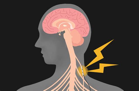 Common Questions About Vagus Nerve Stimulation