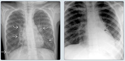 Chest X Ray Asthma