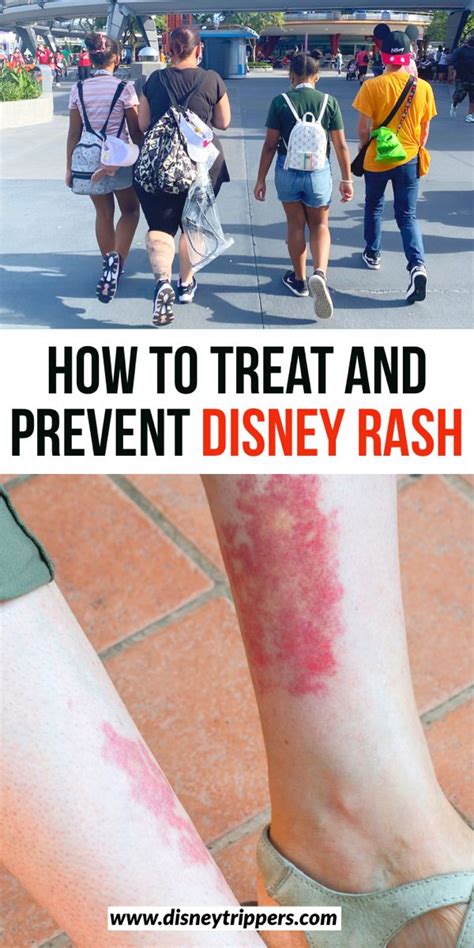 How To Treat And Prevent Disney Rash - Disney Trippers | Disney rash ...