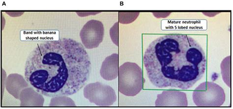 Band Neutrophils