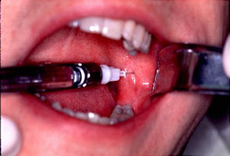 Techniques of Mandibular Anesthesia including Inferior Alveoar Nerve Block