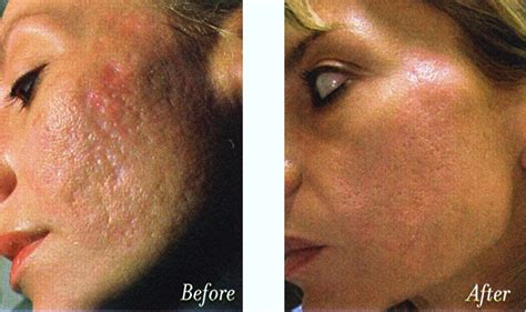 Laser Treatments for Acne Scars