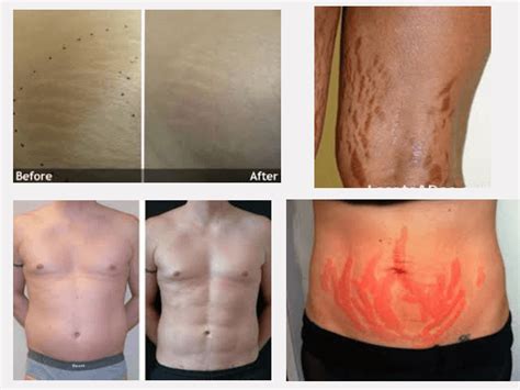 Laser Stretch Mark Removal: The Advanced Way of Removing Stretch Marks