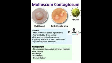 💠 Molluscum contagiosum 💠 - YouTube