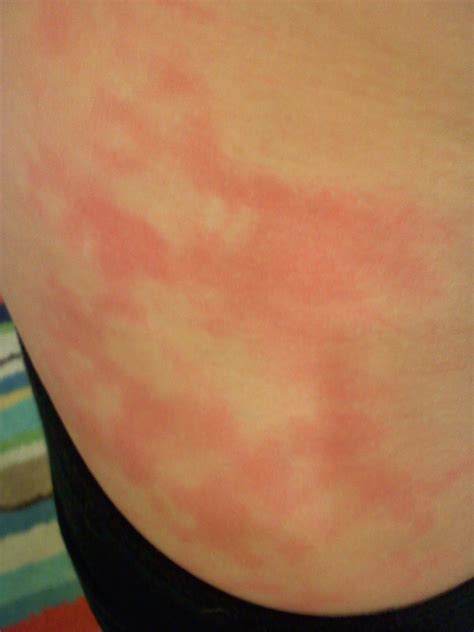 Taking it one bottle at a time: Heat Pad Rash?