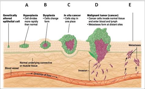 Stages of tumor development and mechanism of metastasis | Download ...