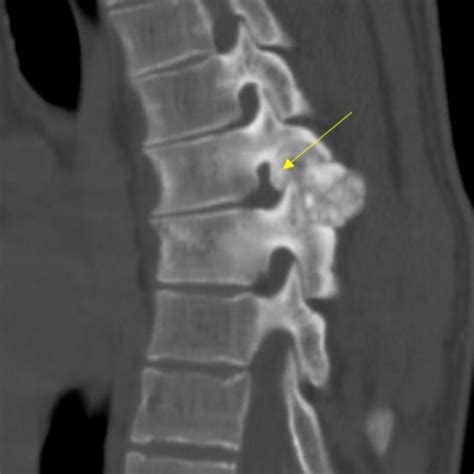 Osteoblastoma - Orthopedics Notes