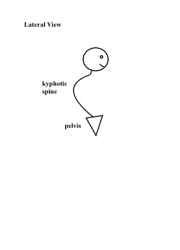 Diagram a kyphosis spinal curvature. Use posterior or lateral views as ...