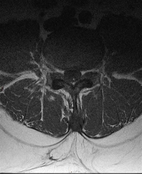 Left L5/S1 disc extrusion | Image | Radiopaedia.org