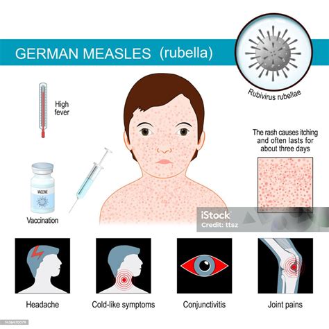 Vetores de Rubéola Infográficos Sobre Sintomas Da Rubéola e mais ...