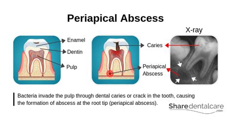 Periapical Abscess Diagram