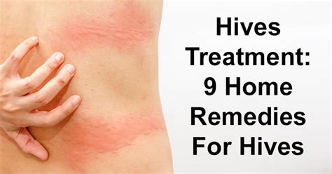 Hives Treatment - fasrsp