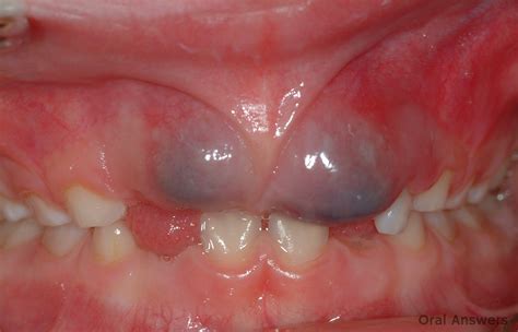 Eruption Cyst: Photos of a Purple Bump on the Gums | Oral Answers