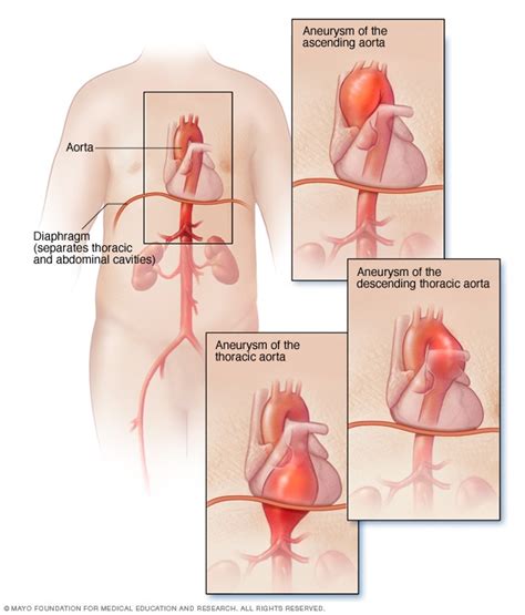 Thoracic aortic aneurysm - Symptoms and causes - Mayo Clinic