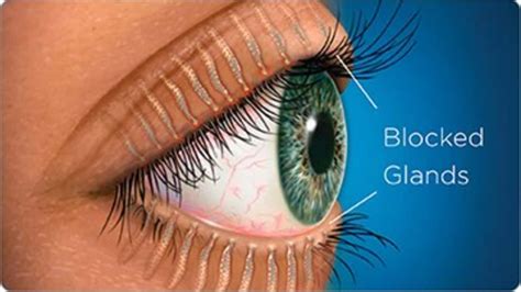 Meibomian Gland Dysfunction: Risk factors, symptoms and treatment ...