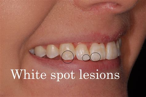 White spots teeth? What are they and how do you get rid of them?