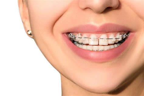 Braces: How They Work & Care in 2020 | Orthodontics, Orthodontist, Best ...