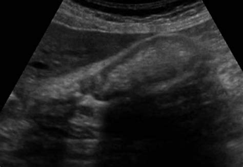 Abdomen and retroperitoneum | 1.2 Gallbladder and bile ducts : Case 1.2 ...