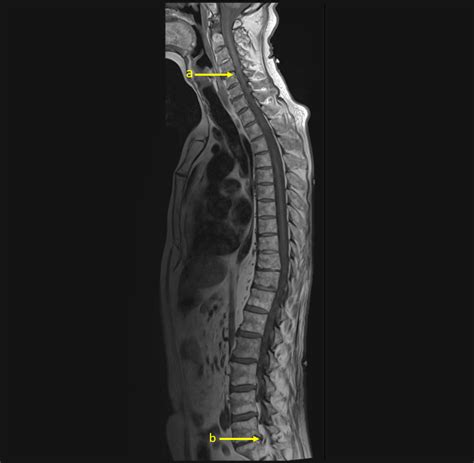 Cureus | A Case of Paraneoplastic Guillain-Barré Syndrome Associated ...