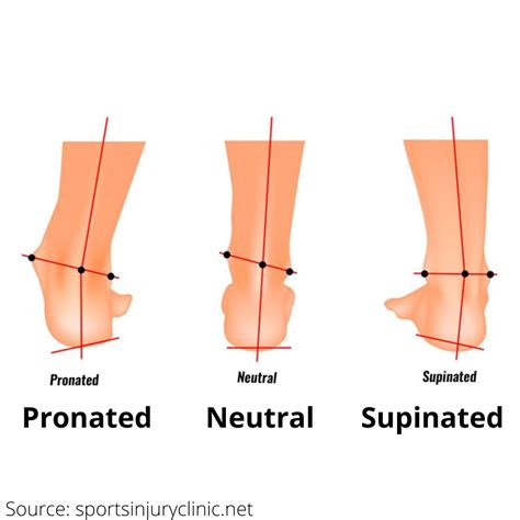 Pronation and Supination of Feet- Causes & Remedies