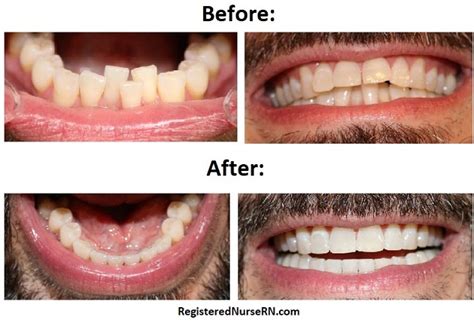 Invisalign (Clear Aligner) Braces Before and After: 3M Clarity