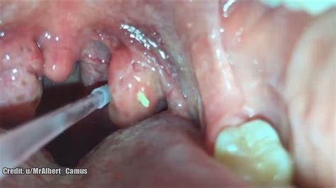 Tonsil Stones Removal, BEST Tonsillolith Treatment Discussion - YouTube