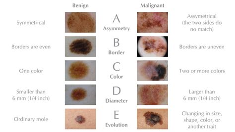 Know Your ABCDEs - AIM at Melanoma Foundation