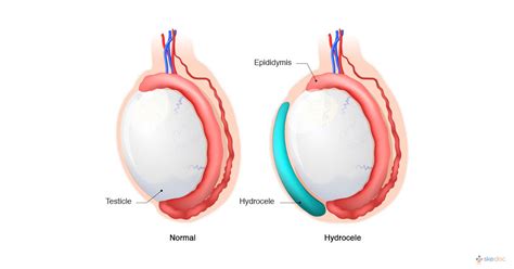 Hydrocele | Symptoms, Treatment, Causes, Risks, and Diagnosis