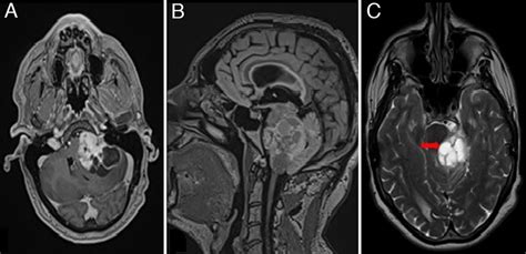 MRI scans before the second surgery showing a large cystic vestibular ...