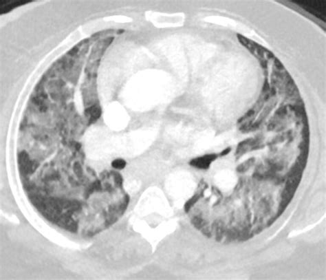 171Lu Acute Inhalational Crack Injury | Lungs