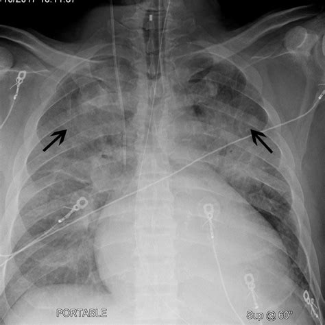 Image: Chest X-Ray of a Patient with Cardiomegaly and Cephalization ...