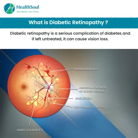 Diabetic Retinopathy: Symptoms, Diagnosis, and Treatment – Healthsoul