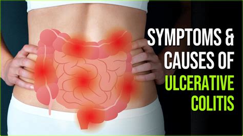 Ulcerative Colitis -Truths About The Common Inflammatory Disorder