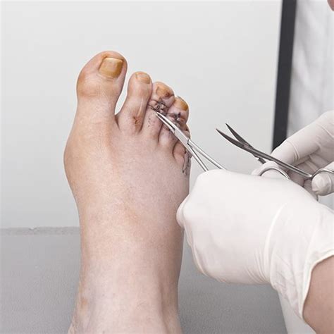 Hammer Toes Correction Flash Sales | aria-database.com