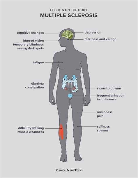 15 symptoms of multiple sclerosis (MS) in women