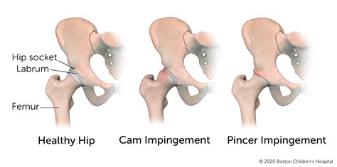 Hip Impingement | Boston Children's Hospital