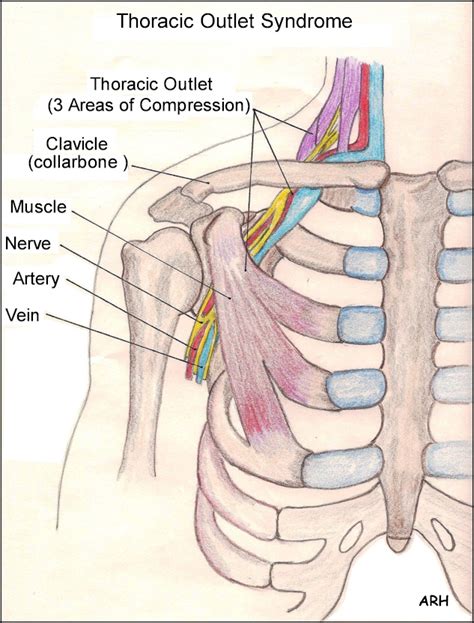 Repetitive Strain Injuries (RSI) Carpal Tunnel Syndrome Symptoms ...