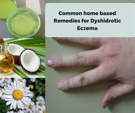 Dyshidrotic Eczema - Natural Home Remedies & Treatment