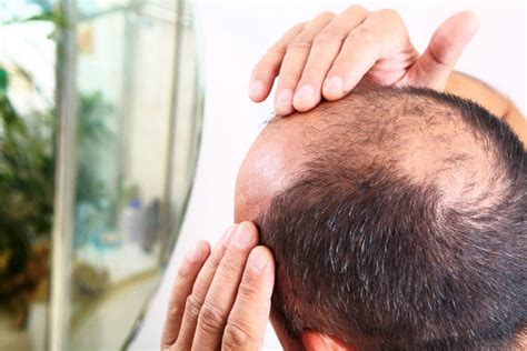 Male Pattern Baldness, Causes, Stages & Treatments