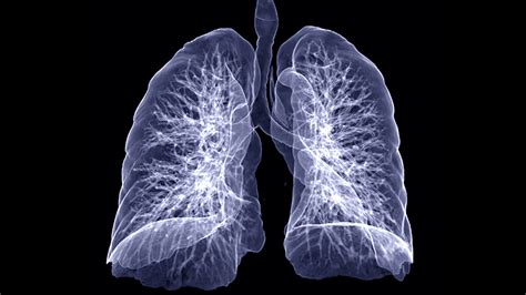 Blood Test May Help Determine if Nodules Detected by CT Scans are Lung ...